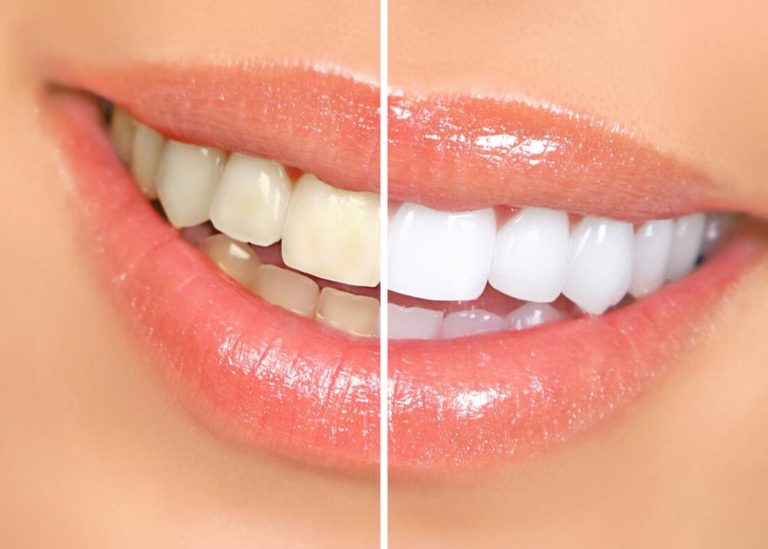 Summer in El Paso Teeth Whitening Specials for Graduation!